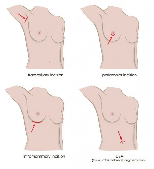 incisions1