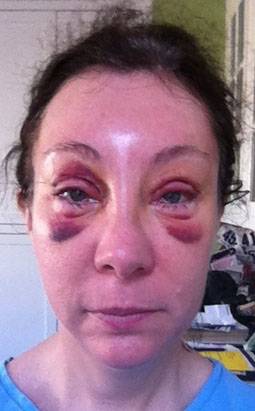 How-long-to-recover-from-blepharoplasty-bruising