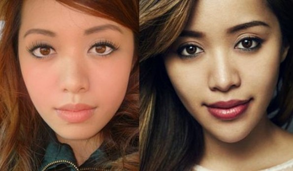 Michelle-Phan-Plastic-Surgery-Chin-Implants