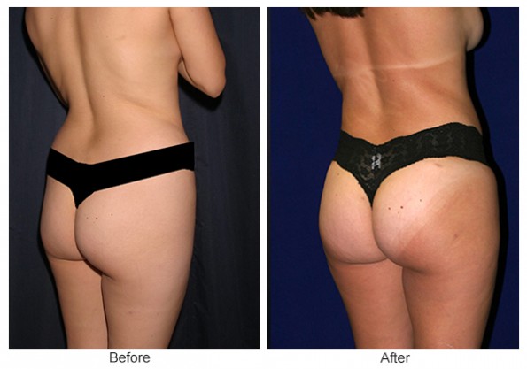 Orange-County-Cosmetic-Surgery-Clinique-Before-After-Buttock-Augmentation-3-Left-Quarter