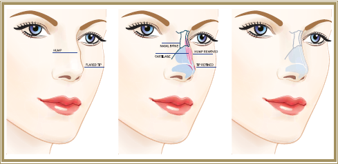 Rhinoplasty