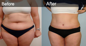 bef-aft-tummytuck