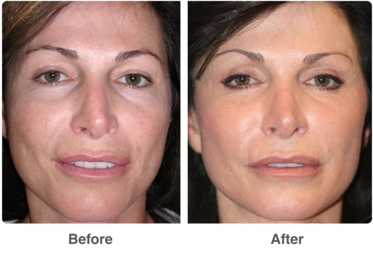 Laser Skin Resurfacing Plastic Surgery