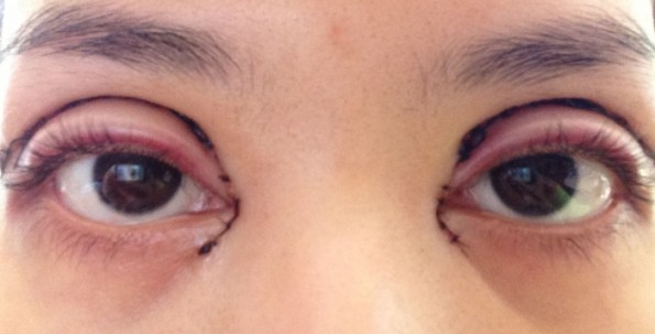 bad double eyelid surgery