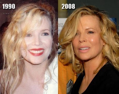 kim-basinger-before-after-plastic-surgery